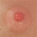 #3 Areola