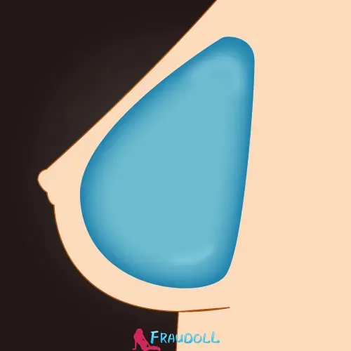 Gel Breasts